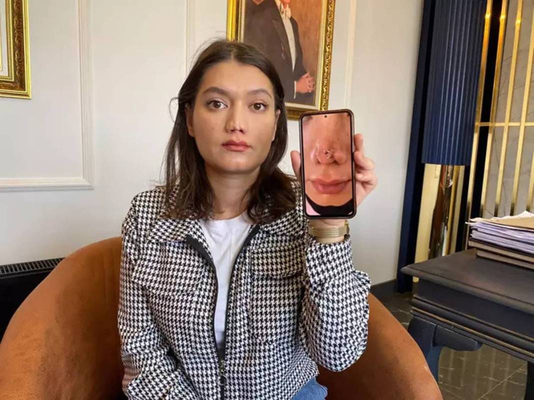 Estetik operasyon sonrası burnu düştü! Aynı doktora iki ameliyat oldu, sonuç değişmedi, mahkemeye verdi 14